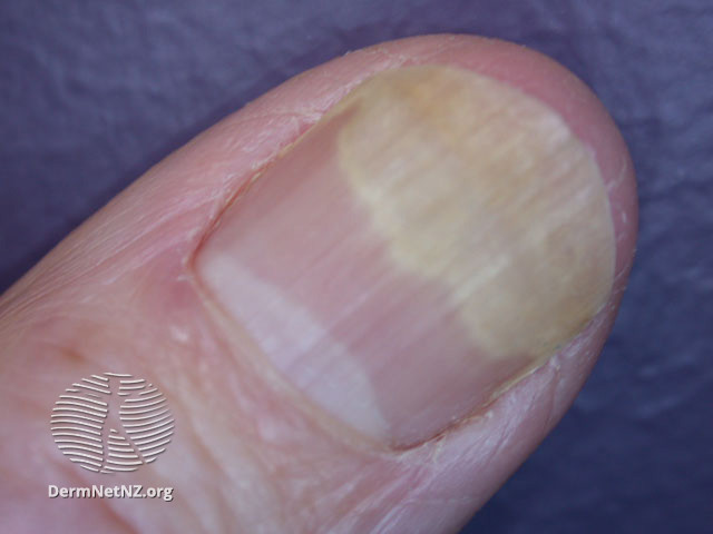 Macro closeup of fingers and dry cuticles of a man in his 20s Stock Photo -  Alamy