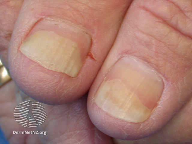 Severe Psoriasis Presenting in 3-Year-Old Child With Nail Dystrophy:  Response to Biologic Treatment - Next Steps in Dermatology