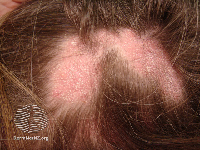 Scarring Alopecia The London Skin And Hair Clinic