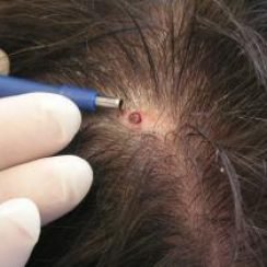 wart on scalp